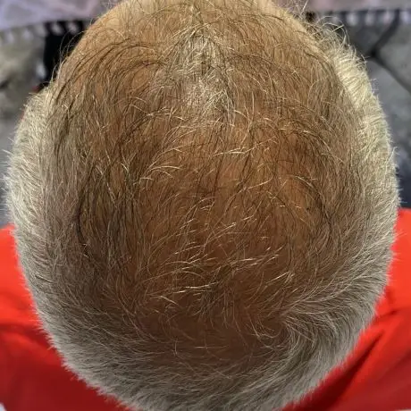 Meta Therapy Haare - mänlicher Kundenkopf mit grauen lichten Haaren nach der Behandlung mit vollem Haar