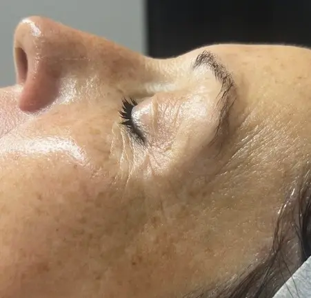 Gesichtsbild Augenparty einer Kundin von Mission immerschön nach einer Falten und Anti-Aging Behandlung
