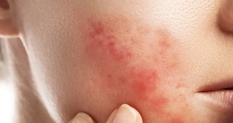 Besichtsausschnitt einer jungen Frau mit Rosacea vor einer Behandlung bei Mission immerschön