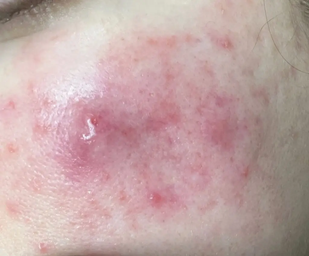 Besichtsausschnitt einer jungen Frau mit Rosacea vor einer Behandlung bei Mission immerschön