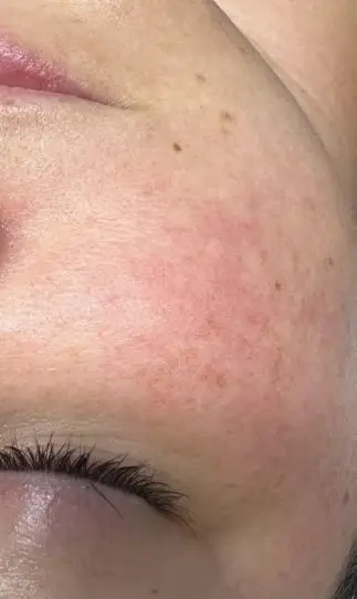Gesichtsausschnitt einer Kundin vom Kosmetikinstitut Mission immerschön mit Rosacea nach einer Behandlung