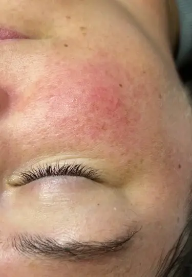 Gesichtsausschnitt einer Kundin vom Kosmetikinstitut Mission immerschön mit Rosacea vor einer Behandlung